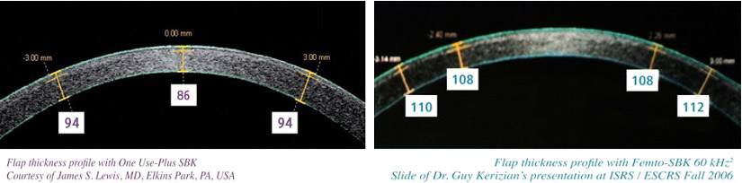 Customized ultra - thin SBK 比飛秒雷射更能精確製作出厚度均等的角膜皮瓣。