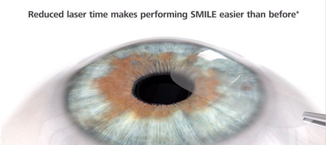SMILE PRO全飛秒近視雷射手術：雷射掃描更綿密，製作透鏡及取出透鏡的時間更短，更舒適且降低風險。